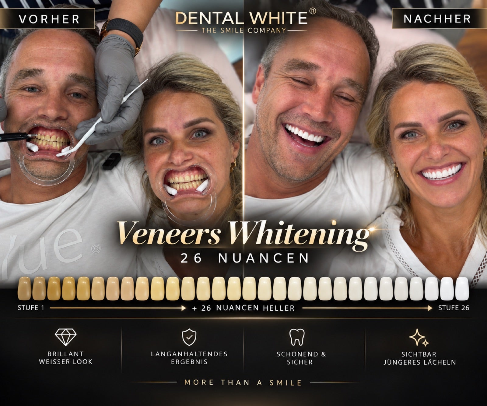 Veneers Whitening Vorher Nachher — 26 Nuancen heller